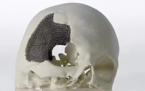 顱骨3D打印技術是什么？